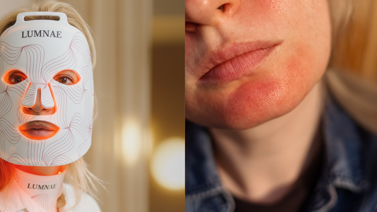 Red Light Therapy for Rosacea: Protocol for Sensitive Skin | Lumnae