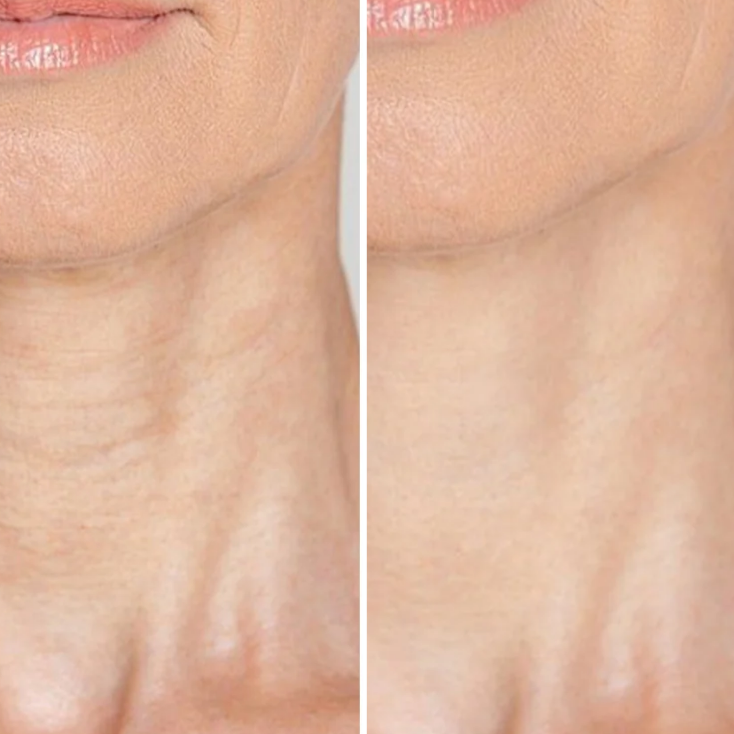 Lumnae™ Face & Neck LED Masks KIT