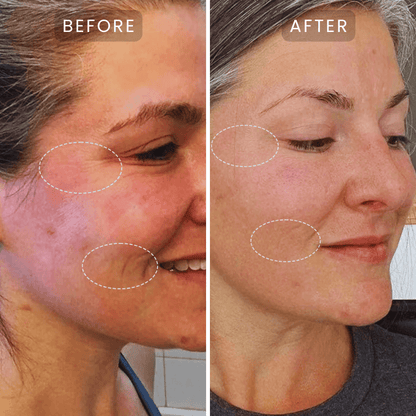 Lumnae Advanced LED Light Therapy Mask