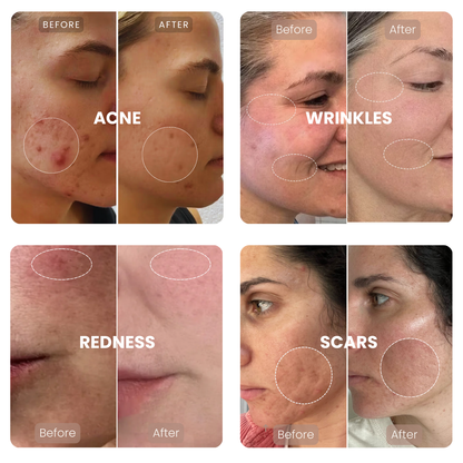 Lumnae™ Advanced LED Light Therapy Mask