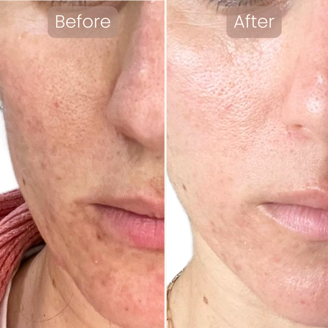 Lumnae™ Advanced LED Light Therapy Mask